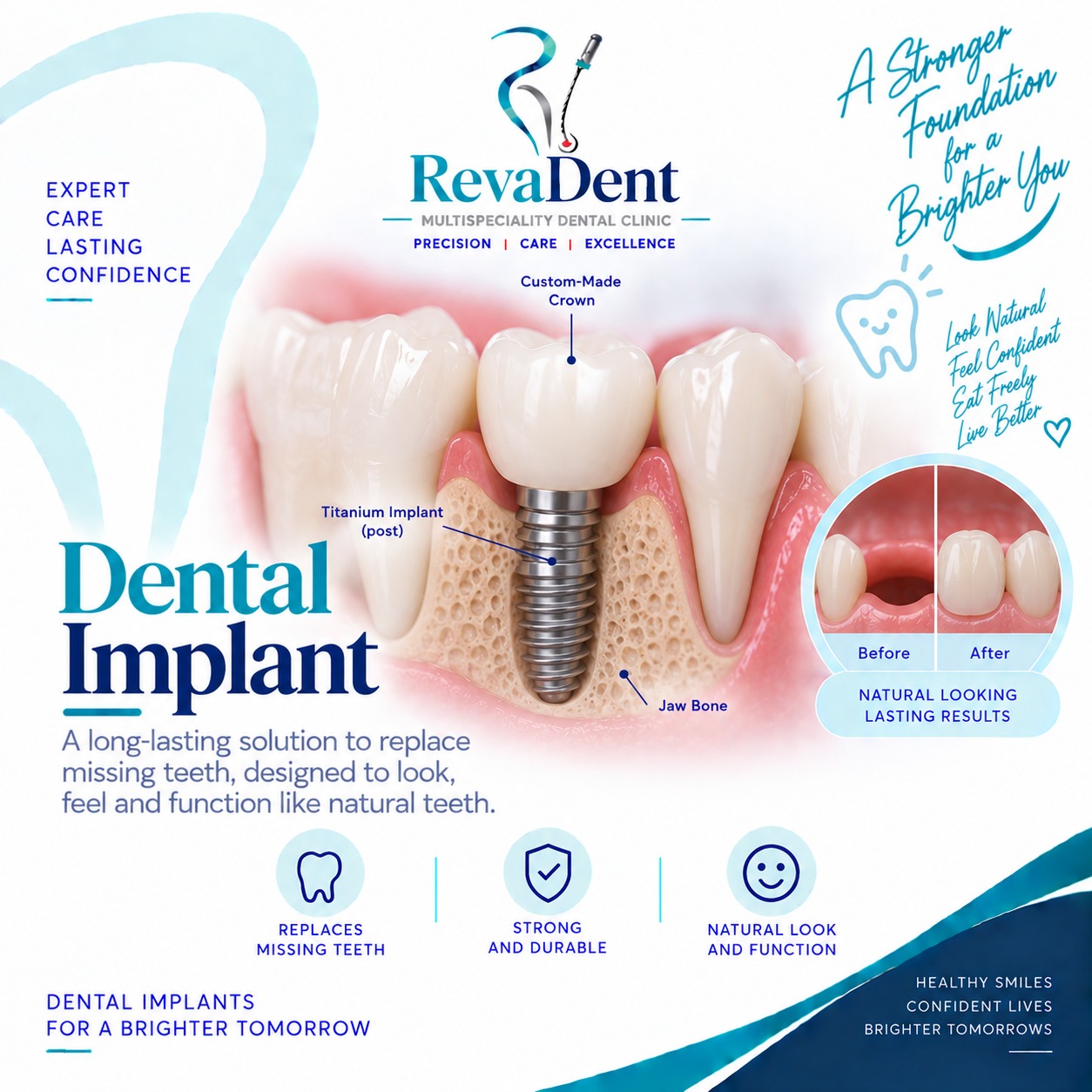 Dental Implants at RevaDent Pimple Saudagar